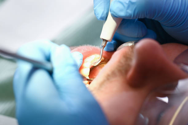 Best Emergency Broken Tooth Repair in Greencastle, IN